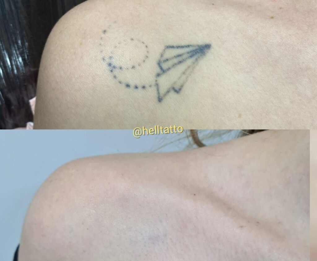 Remover Tatuagem Dor Hell Tattoo Especialistas Em Remo O A Laser