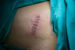 cirurgia para remover tatuagem
