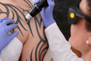 riscos de remover tatuagem a laser
