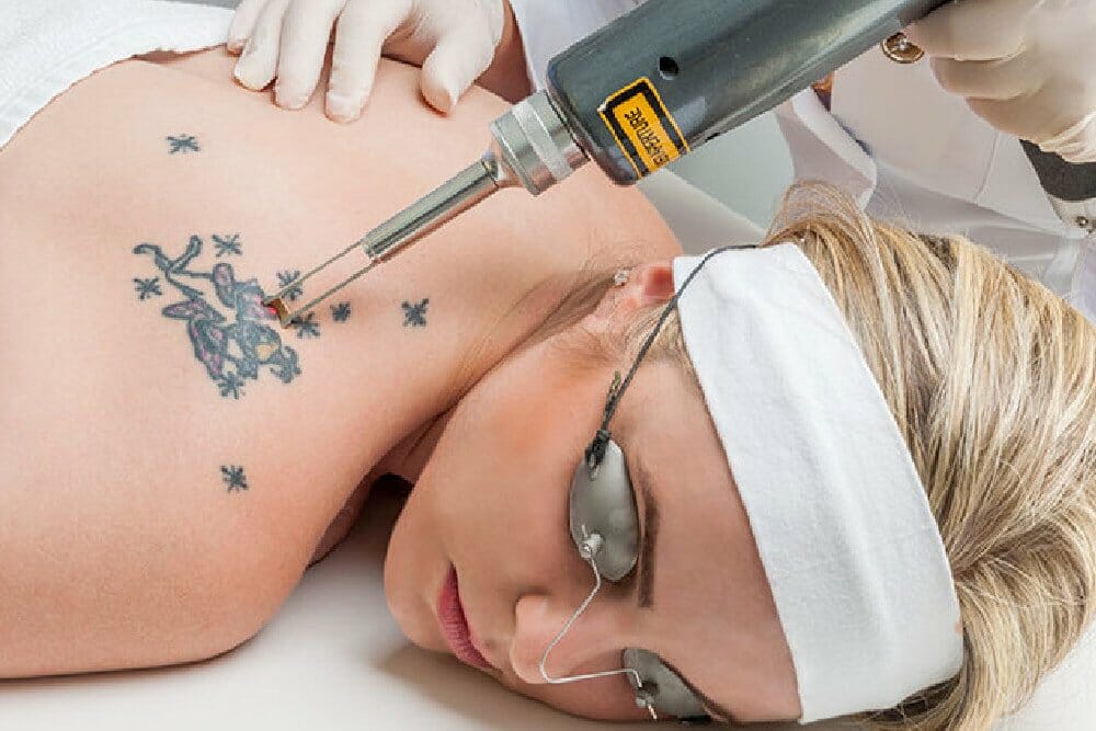 Remover Tatuagem com Laser
