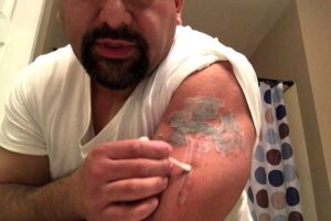 Peeling Acido para remover tatuagem