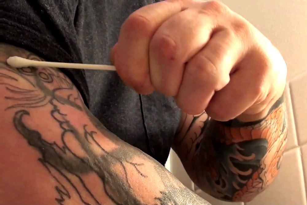 remover tatuagem com peeling ácido