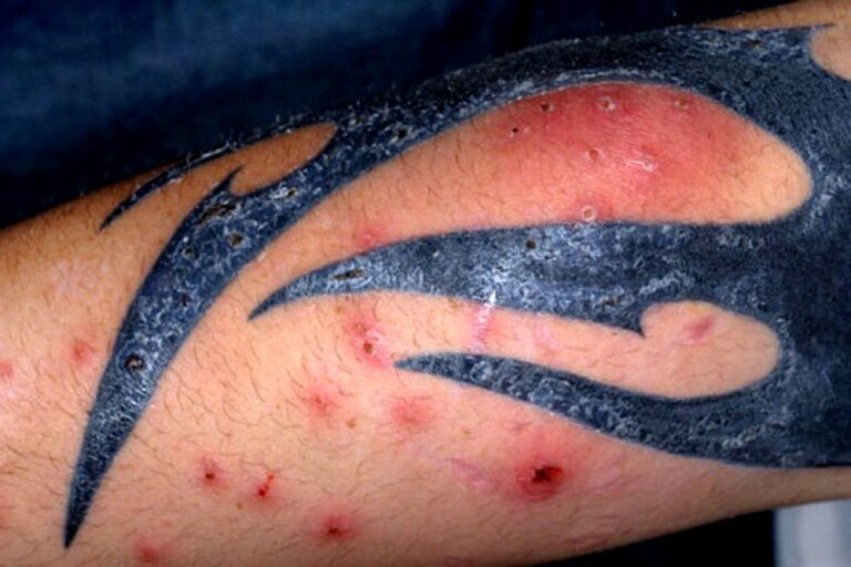 Conheça os principais sintomas de tatuagem inflamada
