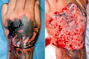 riscos associados a tatuagem