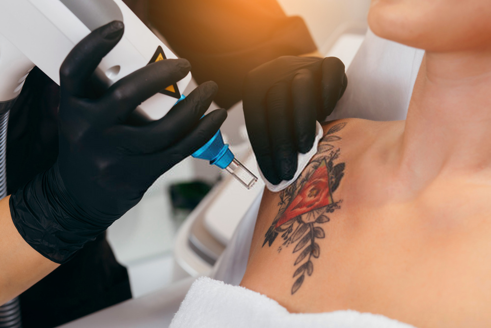 remoção de tatuagem colorida com laser