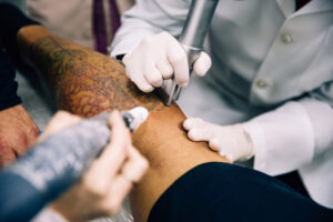 remoção de tatuagem com laser ruby