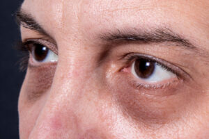 tratamento laser para remoção de olheiras