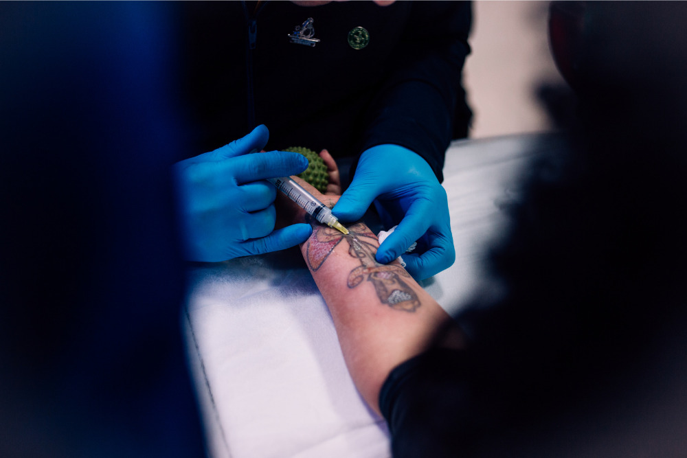 Anestésicos para remoção de tatuagem