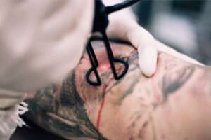 remocao-de-tatuagem-a-laser-como-funciona