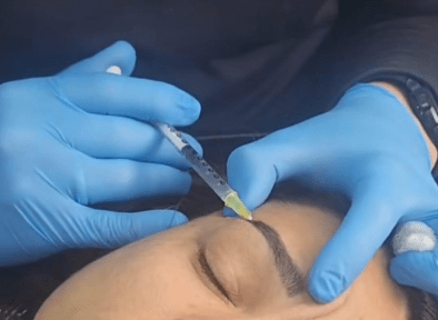 anestesia local para remover sobrancelhas