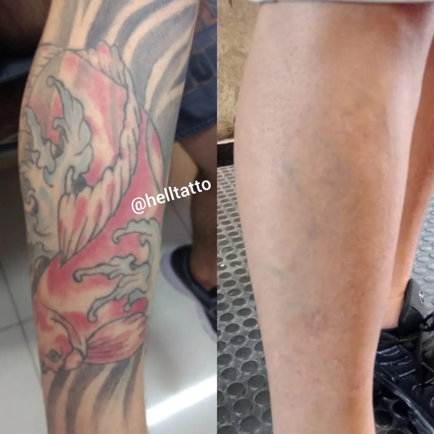 Remocao de tatuagem na perna