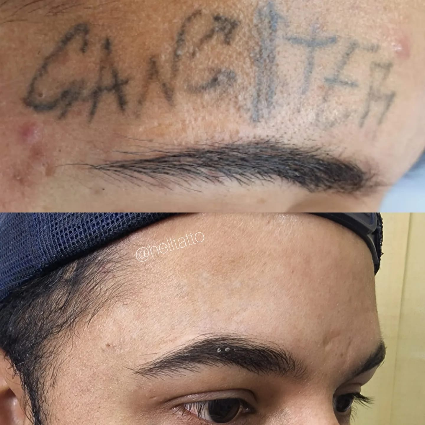 remover tatuagem no rosto