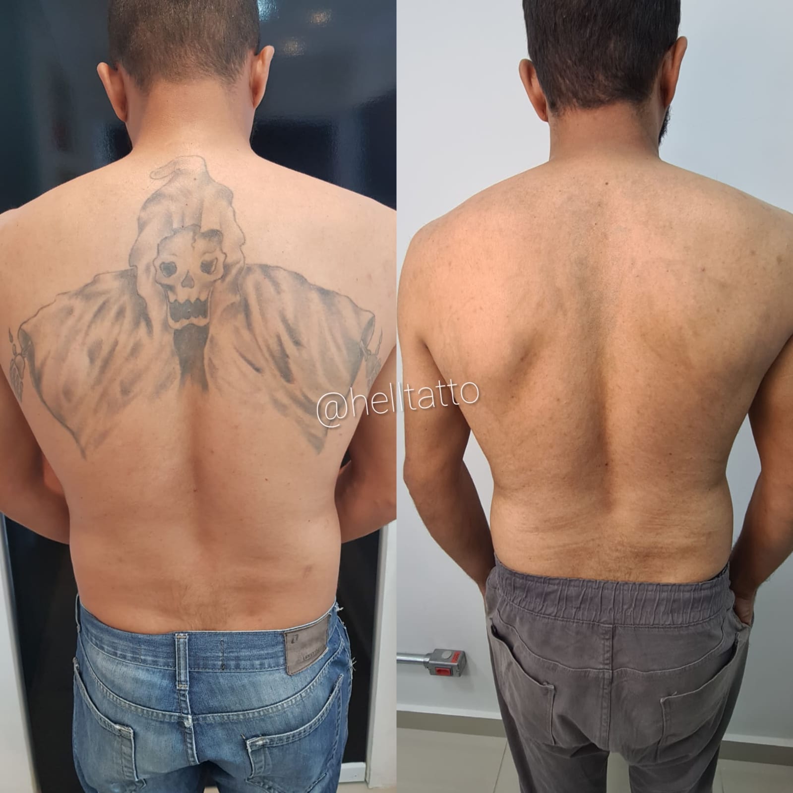 Remover tatuagem nas costas