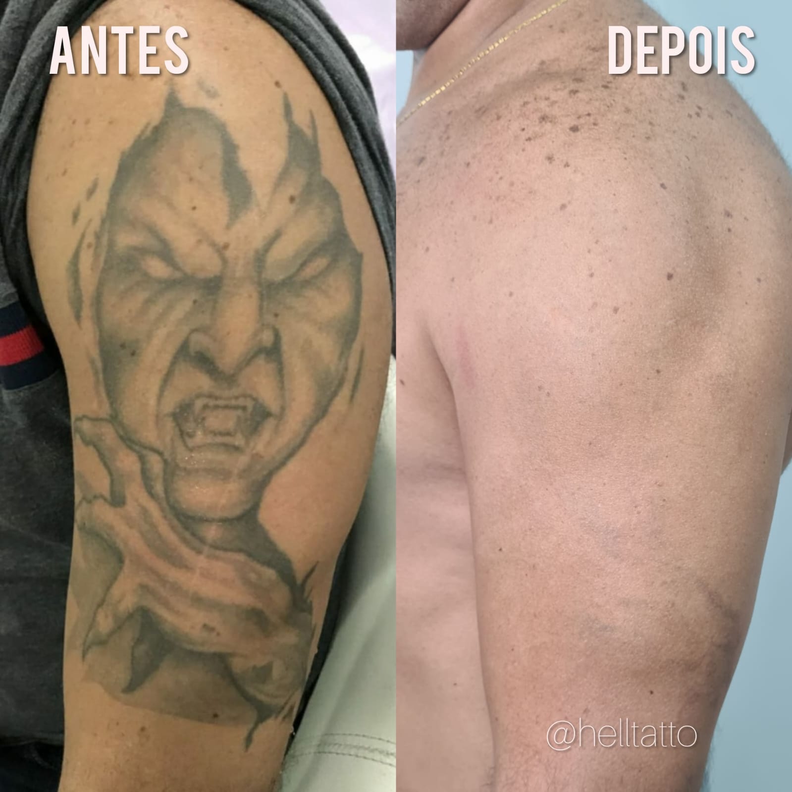 Remover tatuagem no braço