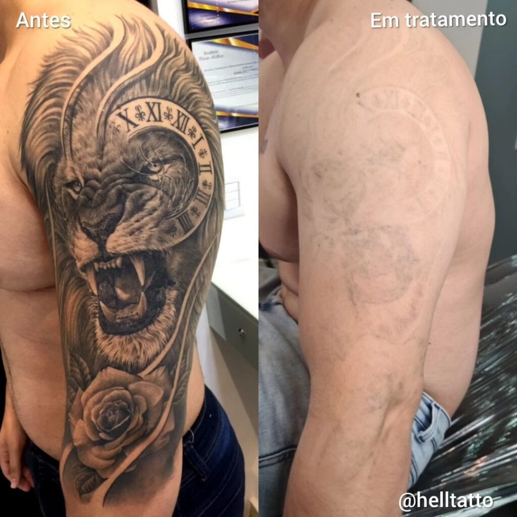 Hell Tattoo Hell Tattoo Especialistas em Remoção a Laser