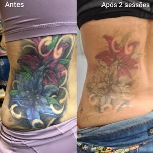 e-possivel-remover-tatuagens-coloridas