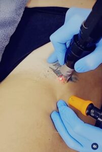 Remoção de tatuagem queima a pele?