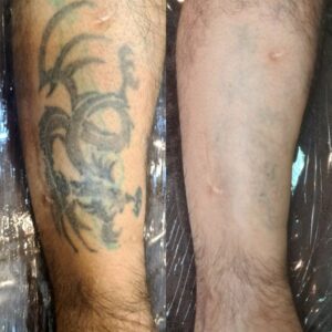 Remover tatuagem mancha a pele