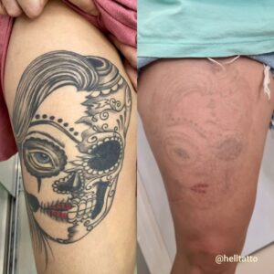 Remoção de tatuagem Hell Tattoo