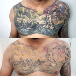 Remoção de tatuagens grandes