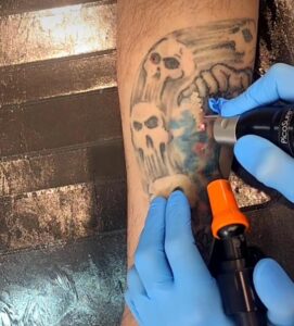 Remoção de tatuagem pelo