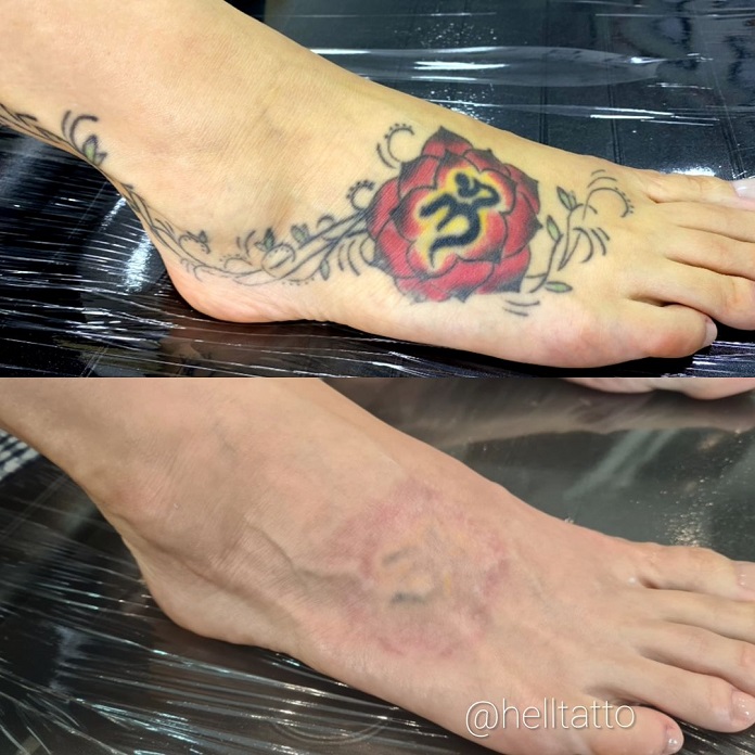 Arquivos Eliminar Tatuagem Em Casa Hell Tattoo Especialistas Em Remoção A Laser 