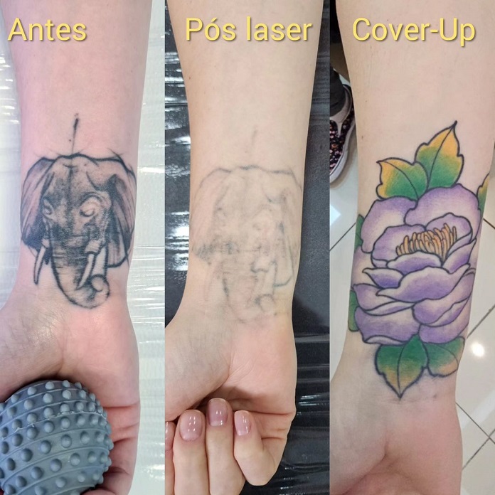 removi-uma-tatuagem-a-laser-posso-fazer-uma-nova-tatuagem-no-lugar