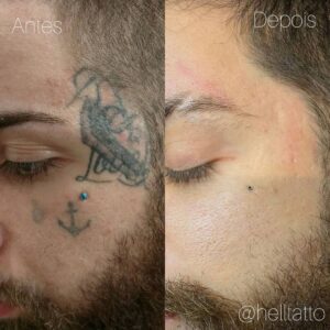 Remoções de tatuagem - Daniel