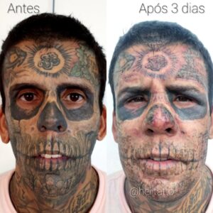 Remoções de tatuagens