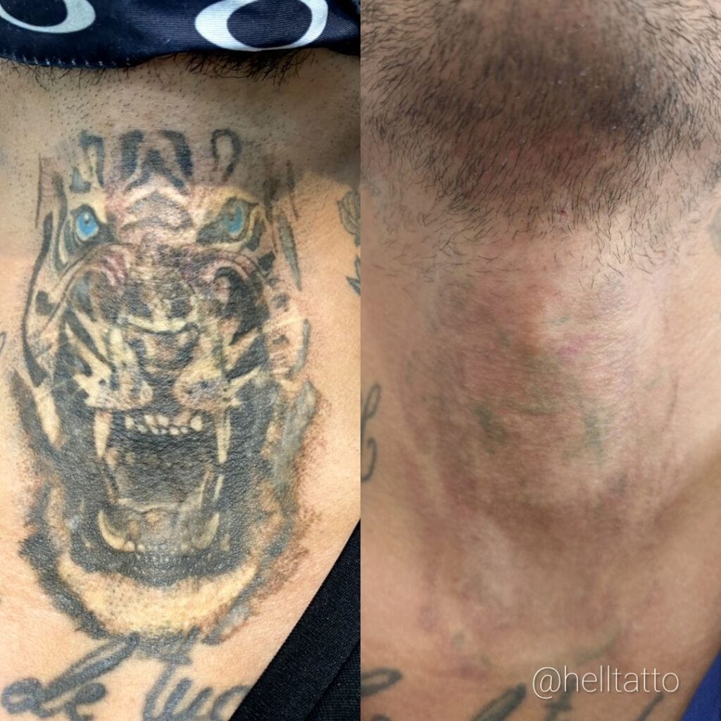 Remoção De Tatuagem 2 Hell Tattoo Especialistas Em Remoção A Laser 