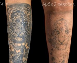 remova-sua-tatuagem-com-confianca-o-processo-passo-a-passo