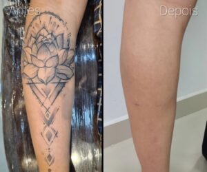 onde-fazer-remocao-de-tatuagem-a-laser-em-marilia