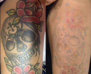 quais-sao-as-diferencas-entre-remocao-de-tatuagem-e-cobertura