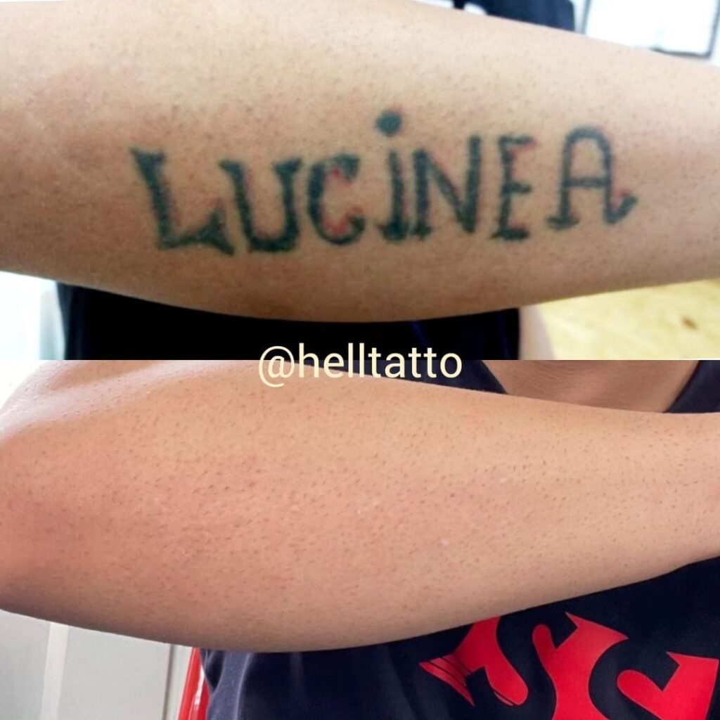 Remoção de tatuagem - Lucineia