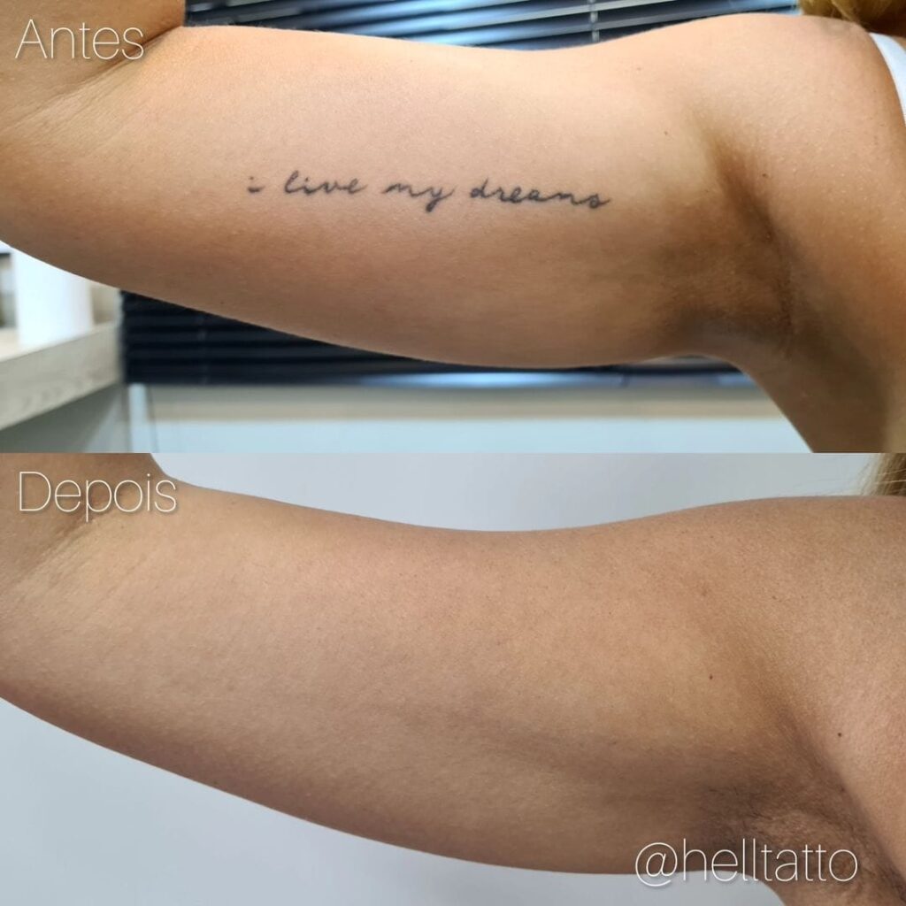 remoção de tatuagem no braço antes e depois