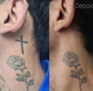 tatuagem-na-adolescencia-e-arrependimento-na-vida-adulta-como-resolver-02