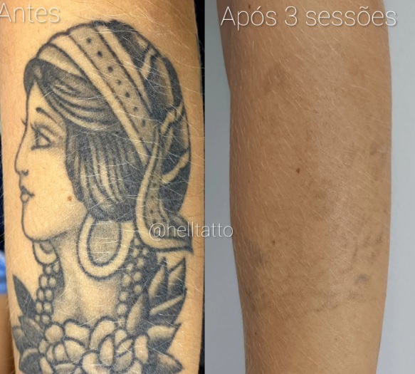 tatuagem-na-adolescencia-e-arrependimento-na-vida-adulta-como-resolver