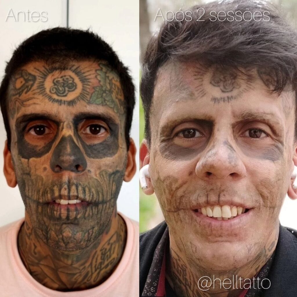 Remoção de tatuagem Leandro na Hell Tattoo