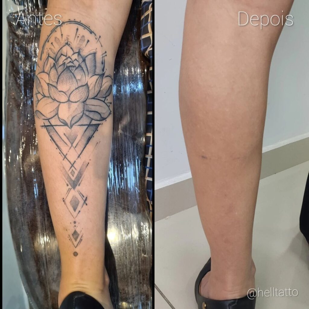 Remoção de tatuagem na perna