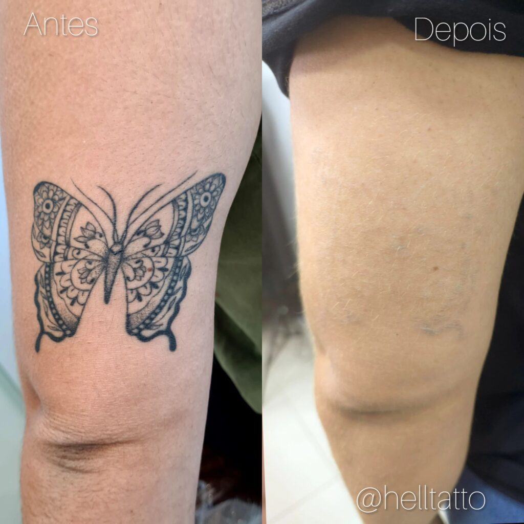 Remoção de tatuagem_autoestima_antes_e_depois