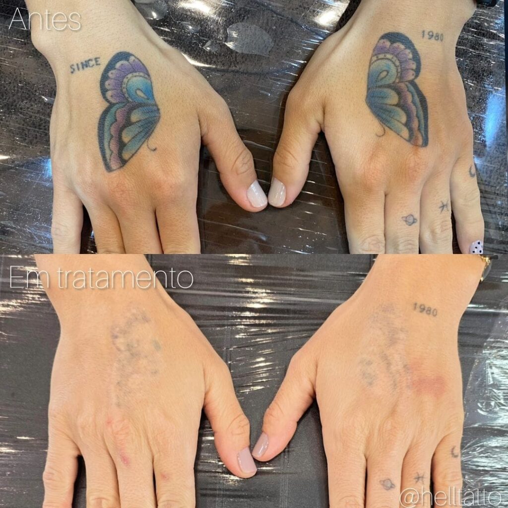 Remoção de tatuagem colorida