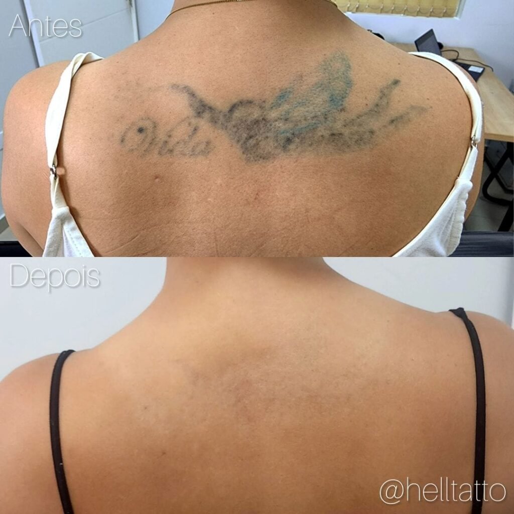 Remoção de tatuagem