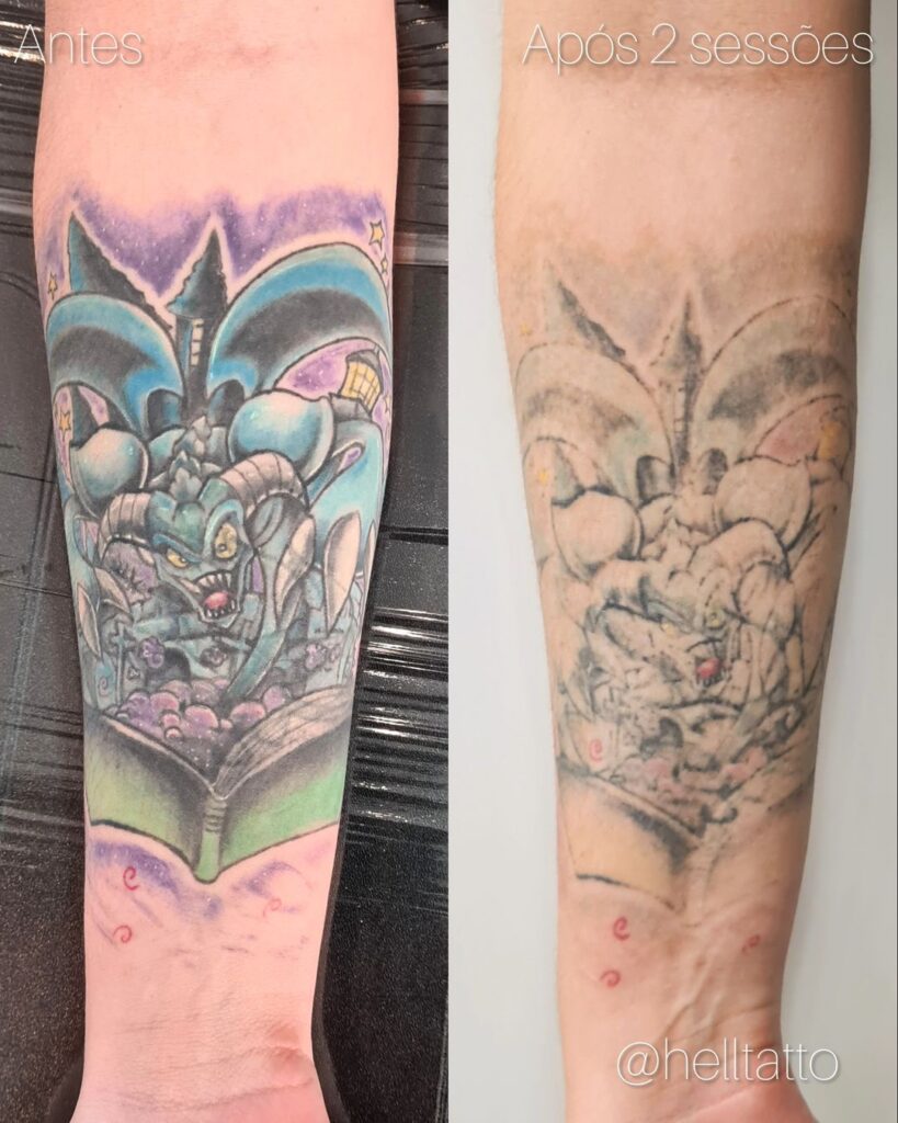 Preço remoção de tatuagem colorida