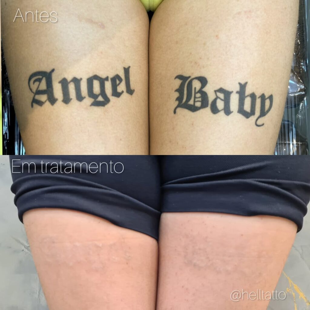 Remoção de tatuagem funciona_veja resultado 2