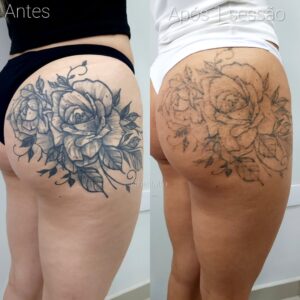 Remoção de tatuagem 1 sessão