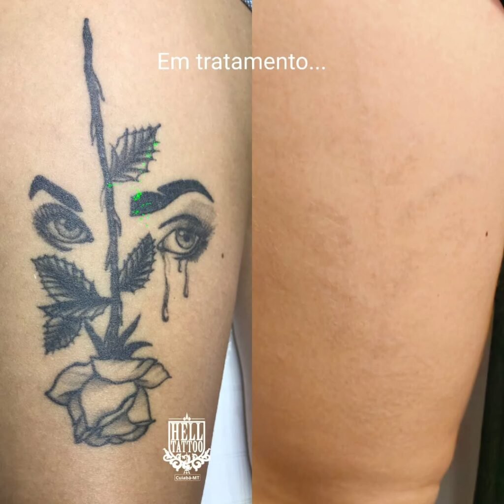 Como fica uma tatuagem apagada com o laser 2