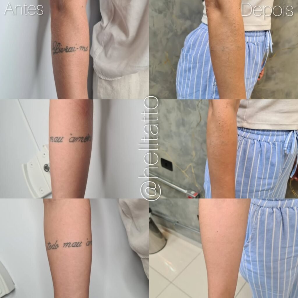 remoção de tatuagem