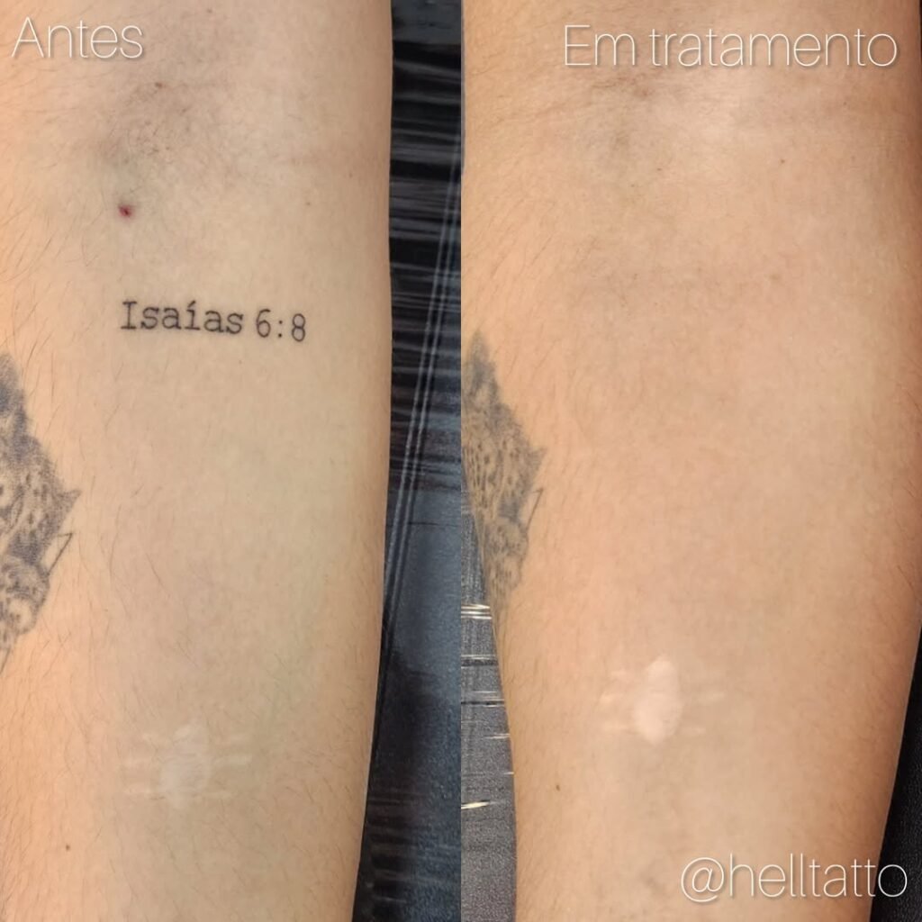 Remoção de Tatuagem é caro