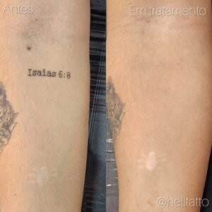 Remoção de Tatuagem é caro