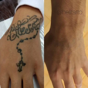 Remoção de tatuagem em pele negra